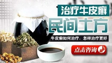 偏方治疗牛皮癣怎么样